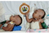 Conjoined Twins sucessfully Separated at University of Ilorin Teaching Hospital Nigeria (Photos)